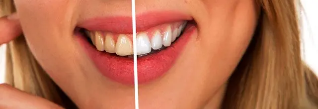 Clareamento dos dentes.